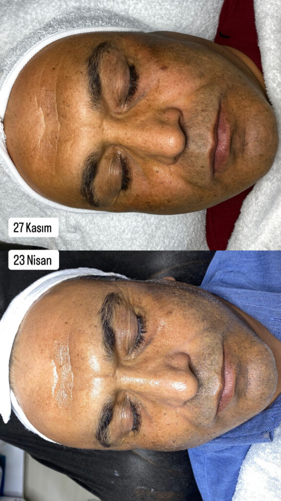 GREEN PEEL