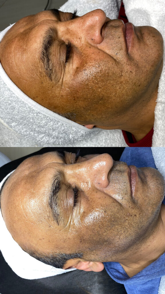 GREEN PEEL