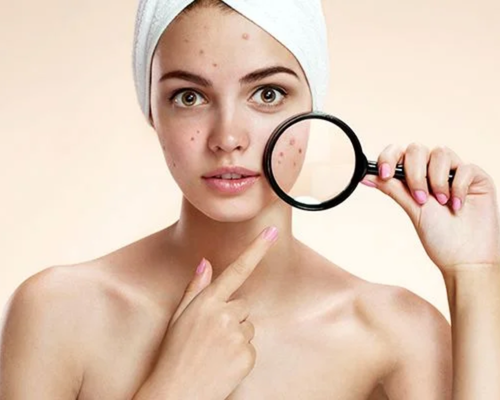 Çanakkale Kleopatra Güzellik Salonu'nda uzmanlar tarafından yapılan akne bakımı uygulaması