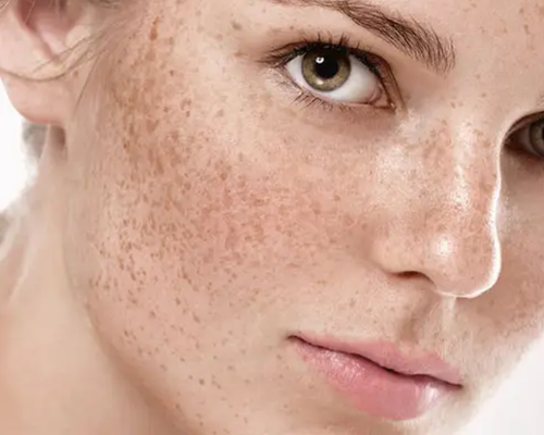 Çanakkale Kleopatra Güzellik Salonu'nda uzmanlar tarafından yapılan De Mela bakımı uygulaması