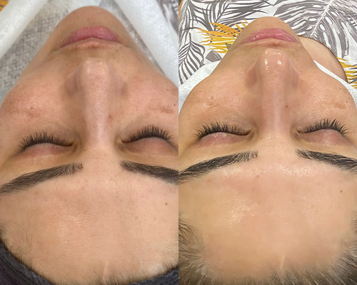 Çanakkale Kleopatra Güzellik Salonu'nda uzmanlar tarafından yapılan Ezco Mask uygulaması