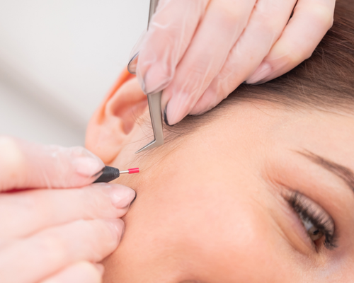 Çanakkale Kleopatra Güzellik Salonu'nda uzmanlar tarafından yapılan iğneli epilasyon uygulaması