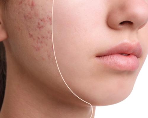 Çanakkale Kleopatra Güzellik Salonu'nda uzmanlar tarafından yapılan ileri akne bakımı uygulaması